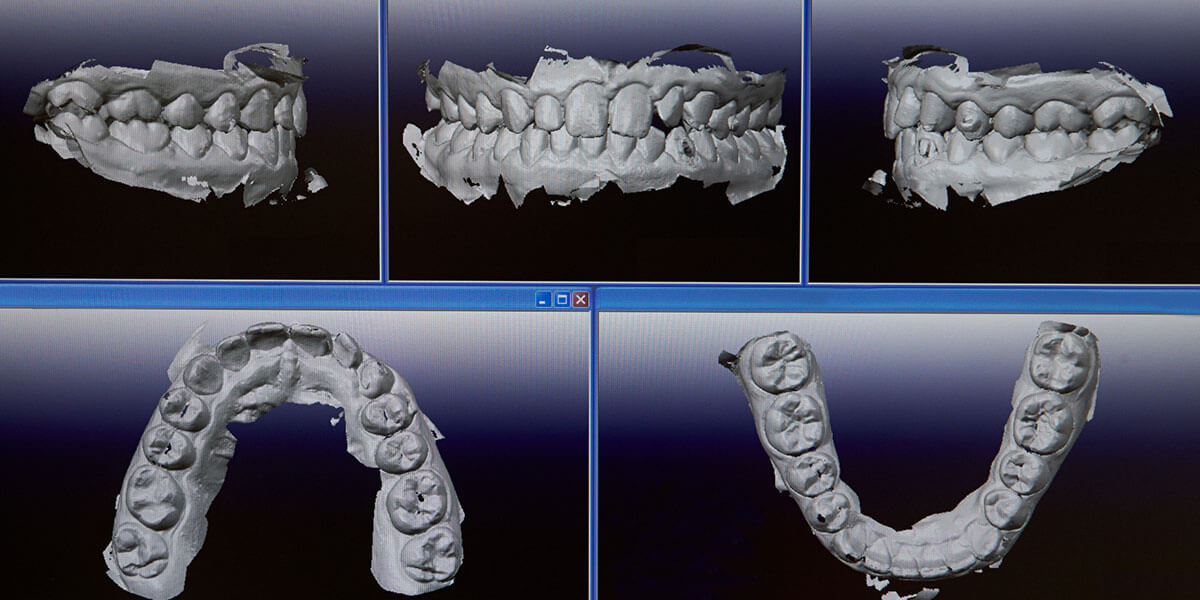 Cone Beam Scanner or Patient